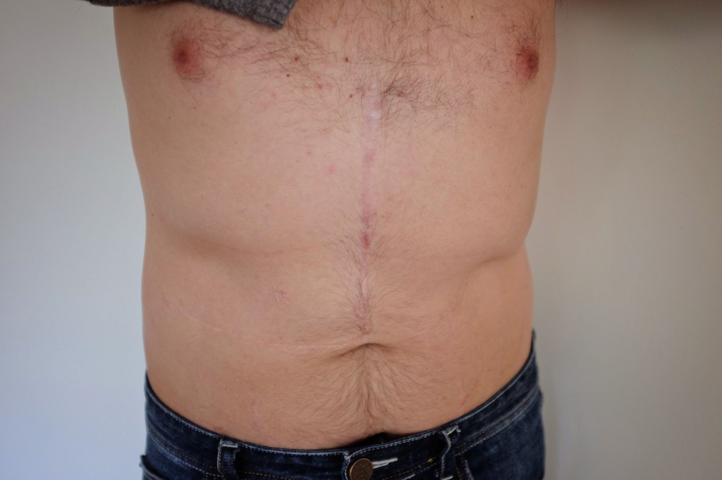 Liver Transplant Scar