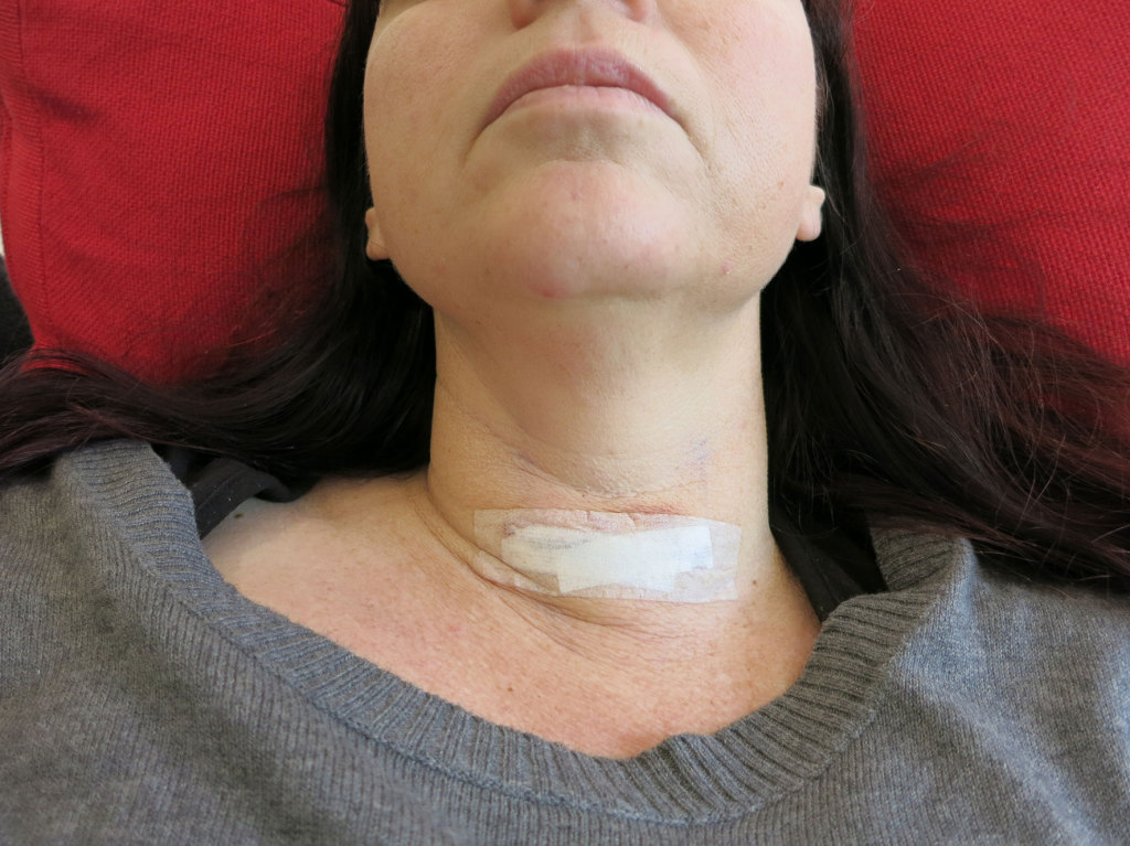 After-Thyroid-Surgery