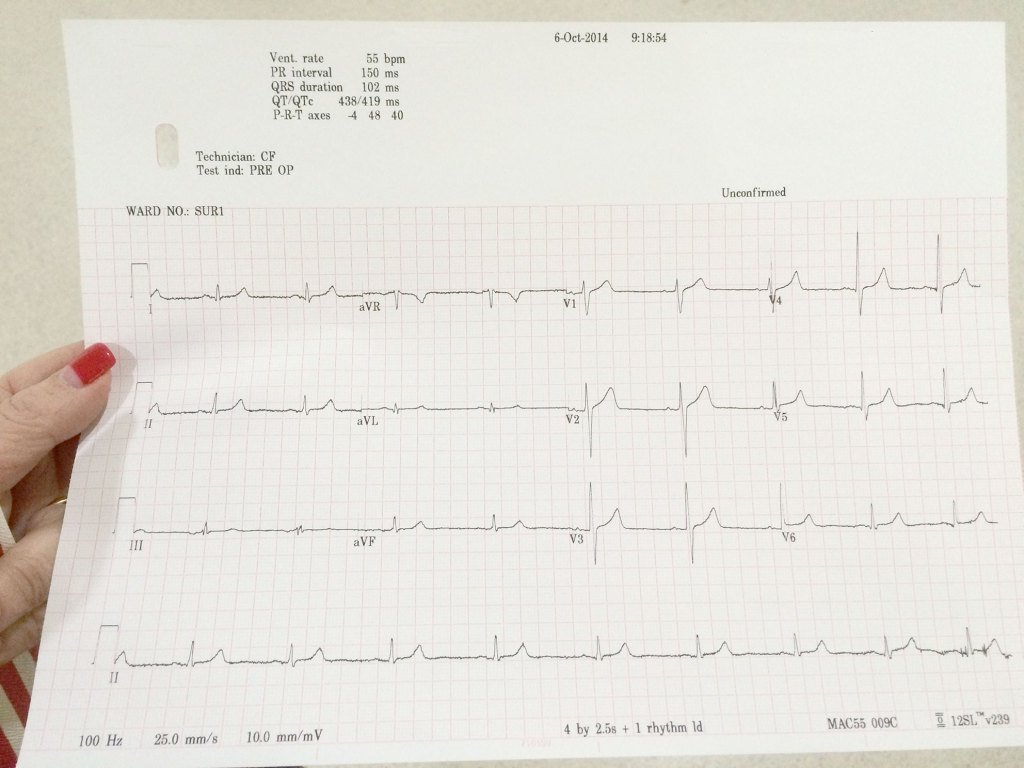 ECG