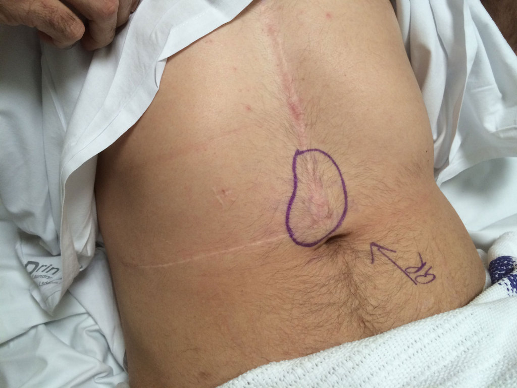 Hernia