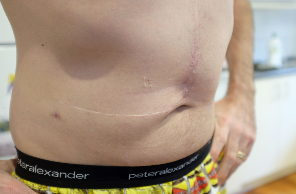 Three-Years-Transplant-Scar