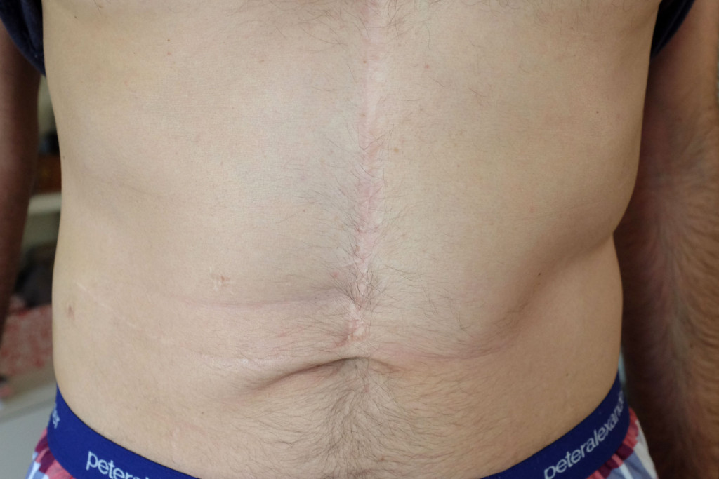 Liver-Transplant-scar-three-years